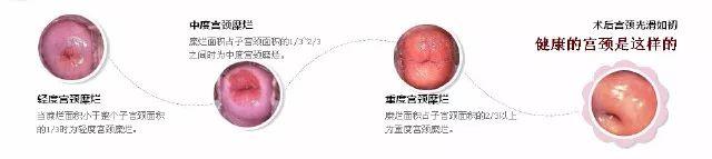 宫颈炎和宫颈糜烂傻傻分不清楚