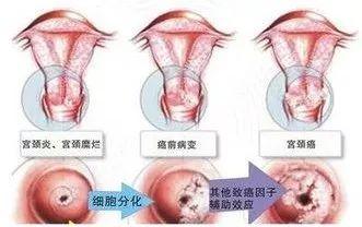 宫颈炎和宫颈糜烂傻傻分不清楚