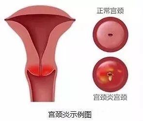 宫颈炎和宫颈糜烂傻傻分不清楚